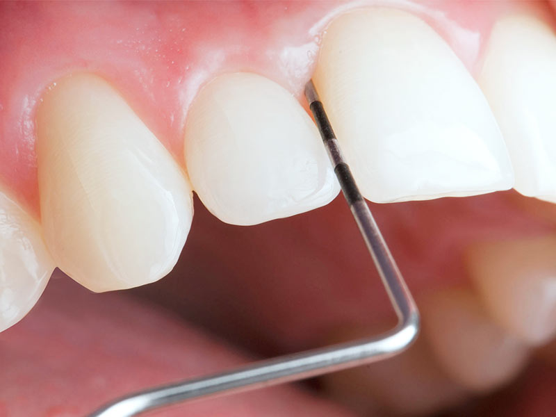 tratamiento-periodontal